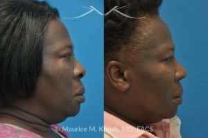 Photo of a patient before and after a procedure. Rhinoplasty to Narrow the Nostrils and Refine the Tip - before-and-after composite photo.