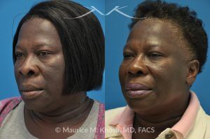 Photo of a patient before and after a procedure. Rhinoplasty to Narrow the Nostrils and Refine the Tip - before-and-after composite photo.