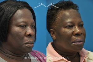 Photo of a patient before and after a procedure. Rhinoplasty to Narrow the Nostrils and Refine the Tip - before-and-after composite photo.