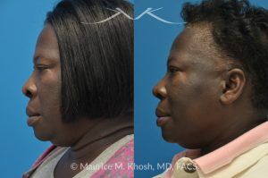 Photo of a patient before and after a procedure. Rhinoplasty to Narrow the Nostrils and Refine the Tip - before-and-after composite photo.
