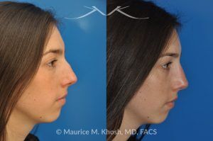 Photo of a patient before and after a procedure. Rhinoplasty to Remove Hump and Improve Breathing - This young lady in her twenties co breathing difficulty and a nasal bony hump. She underwent rhinoplasty through an endo-nasal or closed approach. He nasal hump was removed. She also had cartilage grafts (right sided spreader graft and bilateral alar strut grafts) to support her nasal valve patency.