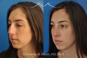 Photo of a patient before and after a procedure. Rhinoplasty to Remove Hump and Improve Breathing - This young lady in her twenties co breathing difficulty and a nasal bony hump. She underwent rhinoplasty through an endo-nasal or closed approach. He nasal hump was removed. She also had cartilage grafts (right sided spreader graft and bilateral alar strut grafts) to support her nasal valve patency.