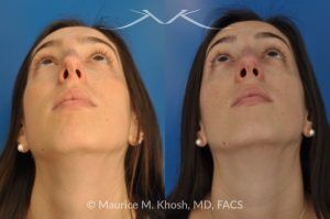 Photo of a patient before and after a procedure. Rhinoplasty to Remove Hump and Improve Breathing - This young lady in her twenties co breathing difficulty and a nasal bony hump. She underwent rhinoplasty through an endo-nasal or closed approach. He nasal hump was removed. She also had cartilage grafts (right sided spreader graft and bilateral alar strut grafts) to support her nasal valve patency.