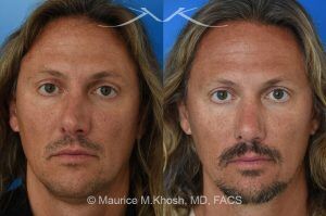 Photo of a patient before and after a procedure. Rhinoplasty for Crooked Nose and Nasal Obstruction - This 44 year old had suffered multiple nose fractures as a young adult. He complained of complete nasal obstruction due a severely deviated septum, and an extremely crooked nose. He was treated through an open rhinoplasty approach. Cadaver rib cartilage was used to straighten his severely deviated septum. Additional cartilage grafts to the bridge of the nose and the left alar region allowed the correction of his functional and cosmetic concerns. He is ecstatic with his results. 