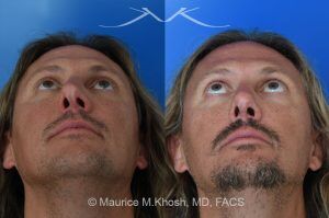 Photo of a patient before and after a procedure. Rhinoplasty for Crooked Nose and Nasal Obstruction - This 44 year old had suffered multiple nose fractures as a young adult. He complained of complete nasal obstruction due a severely deviated septum, and an extremely crooked nose. He was treated through an open rhinoplasty approach. Cadaver rib cartilage was used to straighten his severely deviated septum. Additional cartilage grafts to the bridge of the nose and the left alar region allowed the correction of his functional and cosmetic concerns. He is ecstatic with his results. 