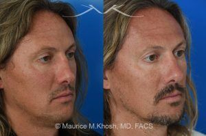 Photo of a patient before and after a procedure. Rhinoplasty for Crooked Nose and Nasal Obstruction - This 44 year old had suffered multiple nose fractures as a young adult. He complained of complete nasal obstruction due a severely deviated septum, and an extremely crooked nose. He was treated through an open rhinoplasty approach. Cadaver rib cartilage was used to straighten his severely deviated septum. Additional cartilage grafts to the bridge of the nose and the left alar region allowed the correction of his functional and cosmetic concerns. He is ecstatic with his results. 