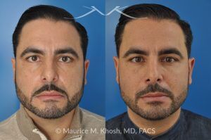Photo of a patient before and after a procedure. Rhinoplasty for Subtle Reduction of the Dorsal Hump and Tip Elevation - before-and-after composite photo.