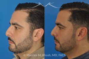 Photo of a patient before and after a procedure. Rhinoplasty for Subtle Reduction of the Dorsal Hump and Tip Elevation - before-and-after composite photo.