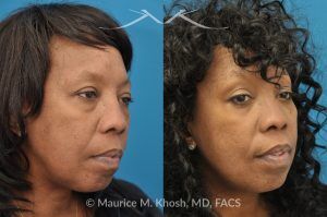 Photo of a patient before and after a procedure. Lower Eyelid Rejuvenation and Temporal Brow Lift - This 55 year old African American lady was interested to addressing lower eyelid puffiness and sagging eyebrow. She underwent lower lid rejuvenation through a trans-conjunctival (inside the eyelid) blepharoplasty and a temporal brow lift.