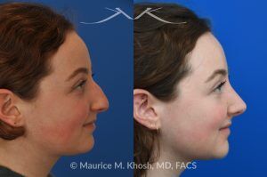 Photo of a patient before and after a procedure. Rhinoplasty for Droopy Tip and Nasal Hump - This delightful 18 year old was not happy with the external appearance of her nose. She disliked the nasal hump, the droopy tip, and the ''unrefined'' shape of her nose. She underwent an open approach rhinoplasty in New York. The dorsal height was reduced, the nasal tip was elevated, and the tip was narrowed and refined. The post op pictures show her at 2 years post op. She is ecstatic with the outcome of her rhinoplasty.