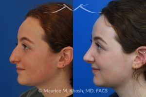Photo of a patient before and after a procedure. Rhinoplasty for Droopy Tip and Nasal Hump - This delightful 18 year old was not happy with the external appearance of her nose. She disliked the nasal hump, the droopy tip, and the ''unrefined'' shape of her nose. She underwent an open approach rhinoplasty in New York. The dorsal height was reduced, the nasal tip was elevated, and the tip was narrowed and refined. The post op pictures show her at 2 years post op. She is ecstatic with the outcome of her rhinoplasty.