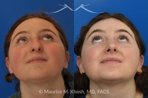 Photo of a patient before and after a procedure. Rhinoplasty for Droopy Tip and Nasal Hump - This delightful 18 year old was not happy with the external appearance of her nose. She disliked the nasal hump, the droopy tip, and the ''unrefined'' shape of her nose. She underwent an open approach rhinoplasty in New York. The dorsal height was reduced, the nasal tip was elevated, and the tip was narrowed and refined. The post op pictures show her at 2 years post op. She is ecstatic with the outcome of her rhinoplasty.
