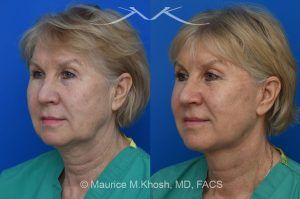 Photo of a patient before and after a procedure. Comprehensive Facial Rejuvenation Surgery - Our delightful patient was interested in overall facial rejuvenation. She underwent lower blepharoplasty with orbital fat repositioning, temporal brow lift, and a deep plane facelift. She is ecstatic with her surgical results.