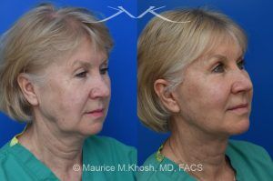 Photo of a patient before and after a procedure. Comprehensive Facial Rejuvenation Surgery - Our delightful patient was interested in overall facial rejuvenation. She underwent lower blepharoplasty with orbital fat repositioning, temporal brow lift, and a deep plane facelift. She is ecstatic with her surgical results.