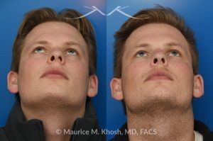 Photo of a patient before and after a procedure. Rhinoplasty with Spreader Graft Improved Symmetry and Breathing - This young patient presented with complaints of nasal obstruction and asymmetric nasal appearance on front view. He had a severe septum deviation and narrowing of the right internal nasal valve due to medial positioning of the upper lateral cartilage. Surgery was performed through a closed approach. Septoplasty was followed by placement of a spreader graft on the right side. The spreader graft not only improved breathing, it also widened the right middle vault and enhanced symmetry of the upper nose in the frontal view.