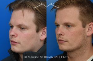 Photo of a patient before and after a procedure. Rhinoplasty with Spreader Graft Improved Symmetry and Breathing - This young patient presented with complaints of nasal obstruction and asymmetric nasal appearance on front view. He had a severe septum deviation and narrowing of the right internal nasal valve due to medial positioning of the upper lateral cartilage. Surgery was performed through a closed approach. Septoplasty was followed by placement of a spreader graft on the right side. The spreader graft not only improved breathing, it also widened the right middle vault and enhanced symmetry of the upper nose in the frontal view.