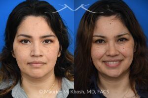 Photo of a patient before and after a procedure. Rhinoplasty For Tip Enhancement Dorsal Hump Reduction And Nostril Narrowing - This rhinoplasty was performed using an open approach. The procedure included reducing the nasal bridge and placing cartilage grafts to support and refine the middle portion of the nose. Controlled bone cuts (osteotomies) were made to narrow the upper nose. The tip was reshaped by trimming and refining the cartilage, placing sutures to create a more defined contour, and flattening the nostrils for balance. Additional support was achieved with a septal extension graft, and the nostril bases were reduced for improved proportion.

The final images display the nose before surgery, the computer-simulated projections, and the achieved postoperative results.