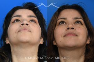 Photo of a patient before and after a procedure. Rhinoplasty For Tip Enhancement Dorsal Hump Reduction And Nostril Narrowing - This rhinoplasty was performed using an open approach. The procedure included reducing the nasal bridge and placing cartilage grafts to support and refine the middle portion of the nose. Controlled bone cuts (osteotomies) were made to narrow the upper nose. The tip was reshaped by trimming and refining the cartilage, placing sutures to create a more defined contour, and flattening the nostrils for balance. Additional support was achieved with a septal extension graft, and the nostril bases were reduced for improved proportion.

The final images display the nose before surgery, the computer-simulated projections, and the achieved postoperative results.