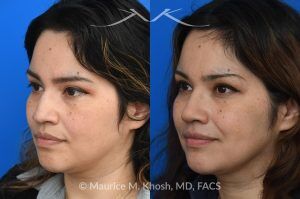 Photo of a patient before and after a procedure. Rhinoplasty For Tip Enhancement Dorsal Hump Reduction And Nostril Narrowing - This rhinoplasty was performed using an open approach. The procedure included reducing the nasal bridge and placing cartilage grafts to support and refine the middle portion of the nose. Controlled bone cuts (osteotomies) were made to narrow the upper nose. The tip was reshaped by trimming and refining the cartilage, placing sutures to create a more defined contour, and flattening the nostrils for balance. Additional support was achieved with a septal extension graft, and the nostril bases were reduced for improved proportion.

The final images display the nose before surgery, the computer-simulated projections, and the achieved postoperative results.