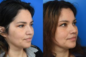 Photo of a patient before and after a procedure. Rhinoplasty For Tip Enhancement Dorsal Hump Reduction And Nostril Narrowing - This rhinoplasty was performed using an open approach. The procedure included reducing the nasal bridge and placing cartilage grafts to support and refine the middle portion of the nose. Controlled bone cuts (osteotomies) were made to narrow the upper nose. The tip was reshaped by trimming and refining the cartilage, placing sutures to create a more defined contour, and flattening the nostrils for balance. Additional support was achieved with a septal extension graft, and the nostril bases were reduced for improved proportion.

The final images display the nose before surgery, the computer-simulated projections, and the achieved postoperative results.