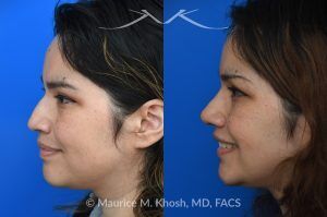 Photo of a patient before and after a procedure. Rhinoplasty For Tip Enhancement Dorsal Hump Reduction And Nostril Narrowing - This rhinoplasty was performed using an open approach. The procedure included reducing the nasal bridge and placing cartilage grafts to support and refine the middle portion of the nose. Controlled bone cuts (osteotomies) were made to narrow the upper nose. The tip was reshaped by trimming and refining the cartilage, placing sutures to create a more defined contour, and flattening the nostrils for balance. Additional support was achieved with a septal extension graft, and the nostril bases were reduced for improved proportion.

The final images display the nose before surgery, the computer-simulated projections, and the achieved postoperative results.