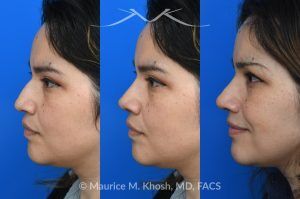 Photo of a patient before and after a procedure. Rhinoplasty For Tip Enhancement Dorsal Hump Reduction And Nostril Narrowing - This rhinoplasty was performed using an open approach. The procedure included reducing the nasal bridge and placing cartilage grafts to support and refine the middle portion of the nose. Controlled bone cuts (osteotomies) were made to narrow the upper nose. The tip was reshaped by trimming and refining the cartilage, placing sutures to create a more defined contour, and flattening the nostrils for balance. Additional support was achieved with a septal extension graft, and the nostril bases were reduced for improved proportion.

The final images display the nose before surgery, the computer-simulated projections, and the achieved postoperative results.