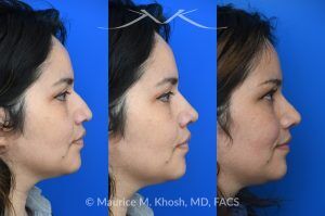 Photo of a patient before and after a procedure. Rhinoplasty For Tip Enhancement Dorsal Hump Reduction And Nostril Narrowing - This rhinoplasty was performed using an open approach. The procedure included reducing the nasal bridge and placing cartilage grafts to support and refine the middle portion of the nose. Controlled bone cuts (osteotomies) were made to narrow the upper nose. The tip was reshaped by trimming and refining the cartilage, placing sutures to create a more defined contour, and flattening the nostrils for balance. Additional support was achieved with a septal extension graft, and the nostril bases were reduced for improved proportion.

The final images display the nose before surgery, the computer-simulated projections, and the achieved postoperative results.