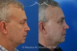 Photo of a patient before and after a procedure. Upper and Lower Blepharoplasty - This delightful 55 year old dislikes the puffy upper and lower eyelids which made him look tired and 'old'. He underwent upper and lower blepharoplasty in Manhattan. The excess skin and fat was removed from the upper eyelid through a perfectly hidden incision. The lower eyelid excess fat was removed from inside the eyelid, so as not to leave any scars.