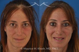 Photo of a patient before and after a procedure. Upper Eyelid Surgery to Remove Excess Skin - This 52 year-old lady was unhappy with droopy and puffy upper eyelids which prevented her from applying eye shadow. She underwent upper eyelid lift, upper blepharoplasty, to get rid of excess skin in the upper eyelid.
