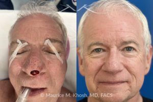 Photo of a patient before and after a procedure. Nasal tip reconstruction after Mohs cancer excision - This lovely patient underwent Mohs excision of basal cell carcinoma of the nasal tip. The defect was repaired with a local flap of nasal skin. The surgery actually helped to improve the nasal appearance by slightly elevating the tip. 