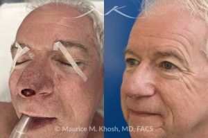 Photo of a patient before and after a procedure. Nasal tip reconstruction after Mohs cancer excision - This lovely patient underwent Mohs excision of basal cell carcinoma of the nasal tip. The defect was repaired with a local flap of nasal skin. The surgery actually helped to improve the nasal appearance by slightly elevating the tip. 