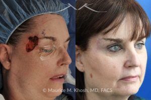 Photo of a patient before and after a procedure. Mohs Defect Repair of the Right Temple and Forehead - This delightful patient was referred for repair of a Moh's defect following excision of a basal cell cancer from the right temple and forehead. Repair was accomplished with a flap repair. The post op results demonstrate her at 6 months following repair. 