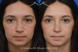 Photo of a patient before and after a procedure. Mole on the left cheek and right side of the nose - before and after removal.