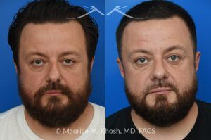Photo of a patient before and after a procedure. Functional & Cosmetic Septo-Rhinoplasty with Nasal Valve Repair - This gentleman suffered from chronic nasal obstruction, which worsened with exercise, and his right nostril collapsed during deep inhalation. His nasal bridge was deviated to the left, and the tip was bulbous. A septo-rhinoplasty was performed to correct these issues. A deviated septum was repaired, and a right-sided spreader graft was used to straighten the nasal bridge. Nostril collapse was corrected with a combination of cephalic trimming of the alar cartilages and alar strut grafts, which also improved the cosmetic appearance of the nasal tip.