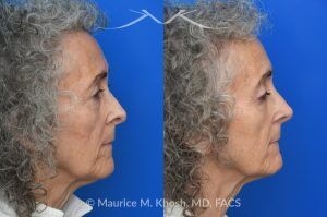 Photo of a patient before and after a procedure. Lower Blepharoplasty with Revision Rhinoplasty 1 - Lower blepharoplasty was performed through an internal (transconjunctival) approach to avoid any external scarring and to minimize the risk of lower eyelid retraction. The patient simultaneously underwent revision rhinoplasty to restore a natural, un-operated nasal appearance and to re-establish normal breathing function.  