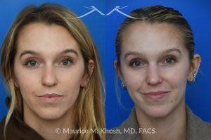 Photo of a patient before and after a procedure. Hump Reduction and Tip Refinement - Our patient came to us seeking a rhinoplasty to refine the overall appearance of her nose. Her goals included smoothing the nasal hump, lifting and narrowing the nasal tip, and preventing the tip from drooping when she smiled. Using an open rhinoplasty approach, we performed dorsal reduction, spreader flaps, cephalic trim, and placement of a septal extension graft to achieve a balanced and stable result.Her 7-month postoperative photos show a beautifully refined yet completely natural outcome that harmonizes with her facial features. She is thrilled with her new nose and the confidence it has brought her.