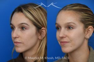 Photo of a patient before and after a procedure. Hump Reduction and Tip Refinement - Our patient came to us seeking a rhinoplasty to refine the overall appearance of her nose. Her goals included smoothing the nasal hump, lifting and narrowing the nasal tip, and preventing the tip from drooping when she smiled. Using an open rhinoplasty approach, we performed dorsal reduction, spreader flaps, cephalic trim, and placement of a septal extension graft to achieve a balanced and stable result.Her 7-month postoperative photos show a beautifully refined yet completely natural outcome that harmonizes with her facial features. She is thrilled with her new nose and the confidence it has brought her.