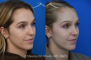 Photo of a patient before and after a procedure. Hump Reduction and Tip Refinement - Our patient came to us seeking a rhinoplasty to refine the overall appearance of her nose. Her goals included smoothing the nasal hump, lifting and narrowing the nasal tip, and preventing the tip from drooping when she smiled. Using an open rhinoplasty approach, we performed dorsal reduction, spreader flaps, cephalic trim, and placement of a septal extension graft to achieve a balanced and stable result.Her 7-month postoperative photos show a beautifully refined yet completely natural outcome that harmonizes with her facial features. She is thrilled with her new nose and the confidence it has brought her.