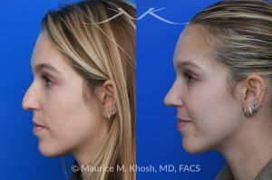 Photo of a patient before and after a procedure. Hump Reduction and Tip Refinement - Our patient came to us seeking a rhinoplasty to refine the overall appearance of her nose. Her goals included smoothing the nasal hump, lifting and narrowing the nasal tip, and preventing the tip from drooping when she smiled. Using an open rhinoplasty approach, we performed dorsal reduction, spreader flaps, cephalic trim, and placement of a septal extension graft to achieve a balanced and stable result.Her 7-month postoperative photos show a beautifully refined yet completely natural outcome that harmonizes with her facial features. She is thrilled with her new nose and the confidence it has brought her.