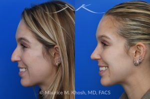 Photo of a patient before and after a procedure. Hump Reduction and Tip Refinement - Our patient came to us seeking a rhinoplasty to refine the overall appearance of her nose. Her goals included smoothing the nasal hump, lifting and narrowing the nasal tip, and preventing the tip from drooping when she smiled. Using an open rhinoplasty approach, we performed dorsal reduction, spreader flaps, cephalic trim, and placement of a septal extension graft to achieve a balanced and stable result.Her 7-month postoperative photos show a beautifully refined yet completely natural outcome that harmonizes with her facial features. She is thrilled with her new nose and the confidence it has brought her.