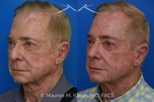 Photo of a patient before and after a procedure. Comprehensive Rhinoplasty and Brow Symmetry Restoration After Forehead Flap Reconstruction - This gentleman sought consultation for enhancement of the nose and increased symmetry in the position of his eyebrows. He had previously undergone excision of a large skin cancer from the right lower nose which was reconstructed with a left forehead flap (skin from the forehead was moved to the nose to cover the surgical defect). The flap resulted in a puffy appearing lower nose and exacerbated the droopy and deviated appearing nasal tip. Additionally, skin removal from the forehead elevated the position of the left eyebrow and resulted in a wide scar in the left upper forehead. 
During rhinoplasty surgery, the contour of the bridge and the tip of was improved and the puffy appearing flap was thinned. The brow lift surgery helped to elevate the right brow to match the position of the left eyebrow. The wide scar in the left forehead was eliminated. 