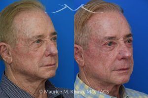 Photo of a patient before and after a procedure. Comprehensive Rhinoplasty and Brow Symmetry Restoration After Forehead Flap Reconstruction - This gentleman sought consultation for enhancement of the nose and increased symmetry in the position of his eyebrows. He had previously undergone excision of a large skin cancer from the right lower nose which was reconstructed with a left forehead flap (skin from the forehead was moved to the nose to cover the surgical defect). The flap resulted in a puffy appearing lower nose and exacerbated the droopy and deviated appearing nasal tip. Additionally, skin removal from the forehead elevated the position of the left eyebrow and resulted in a wide scar in the left upper forehead. 
During rhinoplasty surgery, the contour of the bridge and the tip of was improved and the puffy appearing flap was thinned. The brow lift surgery helped to elevate the right brow to match the position of the left eyebrow. The wide scar in the left forehead was eliminated. 