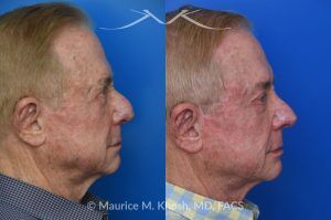 Photo of a patient before and after a procedure. Comprehensive Rhinoplasty and Brow Symmetry Restoration After Forehead Flap Reconstruction - This gentleman sought consultation for enhancement of the nose and increased symmetry in the position of his eyebrows. He had previously undergone excision of a large skin cancer from the right lower nose which was reconstructed with a left forehead flap (skin from the forehead was moved to the nose to cover the surgical defect). The flap resulted in a puffy appearing lower nose and exacerbated the droopy and deviated appearing nasal tip. Additionally, skin removal from the forehead elevated the position of the left eyebrow and resulted in a wide scar in the left upper forehead. 
During rhinoplasty surgery, the contour of the bridge and the tip of was improved and the puffy appearing flap was thinned. The brow lift surgery helped to elevate the right brow to match the position of the left eyebrow. The wide scar in the left forehead was eliminated. 