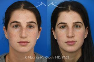 Photo of a patient before and after a procedure. Open Rhinoplasty for C-Shaped Deviation and Dorsal Hump Reduction - Open rhinoplasty was performed to correct a C-shaped dorsal deviation, reduce a dorsal hump on profile view, and elevate a ptotic nasal tip. A septoplasty was carried out concurrently to address septal deviation and to harvest cartilage for grafting. Following dorsal reduction, spreader grafts were placed—two layered on the left side—to restore dorsal aesthetic lines and improve symmetry. Bilateral lateral osteotomies and a left-sided intermediate osteotomy were performed to realign the nasal bones. Tip elevation and support were maintained with septo-columellar sutures.