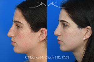 Photo of a patient before and after a procedure. Open Rhinoplasty for C-Shaped Deviation and Dorsal Hump Reduction - Open rhinoplasty was performed to correct a C-shaped dorsal deviation, reduce a dorsal hump on profile view, and elevate a ptotic nasal tip. A septoplasty was carried out concurrently to address septal deviation and to harvest cartilage for grafting. Following dorsal reduction, spreader grafts were placed—two layered on the left side—to restore dorsal aesthetic lines and improve symmetry. Bilateral lateral osteotomies and a left-sided intermediate osteotomy were performed to realign the nasal bones. Tip elevation and support were maintained with septo-columellar sutures.