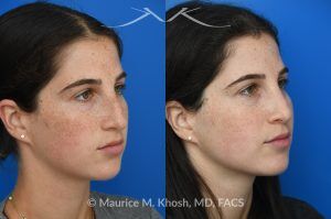 Photo of a patient before and after a procedure. Open Rhinoplasty for C-Shaped Deviation and Dorsal Hump Reduction - Open rhinoplasty was performed to correct a C-shaped dorsal deviation, reduce a dorsal hump on profile view, and elevate a ptotic nasal tip. A septoplasty was carried out concurrently to address septal deviation and to harvest cartilage for grafting. Following dorsal reduction, spreader grafts were placed—two layered on the left side—to restore dorsal aesthetic lines and improve symmetry. Bilateral lateral osteotomies and a left-sided intermediate osteotomy were performed to realign the nasal bones. Tip elevation and support were maintained with septo-columellar sutures.