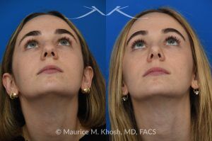 Photo of a patient before and after a procedure. Rhinoplasty to Smooth a Dorsal Hump and Narrow and Refine the Tip - This young patient sought to refine her nose while preserving her natural features. An open approach rhinoplasty was performed, including a conservative dorsal shave, cephalic trimming of the alar cartilages, and placement of alar strut grafts to support and straighten the alae. We used a septal extension graft to precisely control nasal tip rotation and projection, and performed osteotomies to narrow the bony bridge.