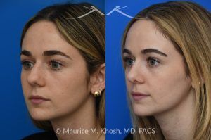 Photo of a patient before and after a procedure. Rhinoplasty to Smooth a Dorsal Hump and Narrow and Refine the Tip - This young patient sought to refine her nose while preserving her natural features. An open approach rhinoplasty was performed, including a conservative dorsal shave, cephalic trimming of the alar cartilages, and placement of alar strut grafts to support and straighten the alae. We used a septal extension graft to precisely control nasal tip rotation and projection, and performed osteotomies to narrow the bony bridge.