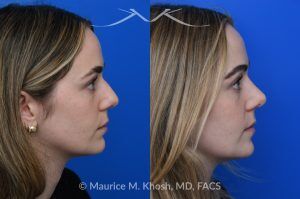Photo of a patient before and after a procedure. Rhinoplasty to Smooth a Dorsal Hump and Narrow and Refine the Tip - This young patient sought to refine her nose while preserving her natural features. An open approach rhinoplasty was performed, including a conservative dorsal shave, cephalic trimming of the alar cartilages, and placement of alar strut grafts to support and straighten the alae. We used a septal extension graft to precisely control nasal tip rotation and projection, and performed osteotomies to narrow the bony bridge.