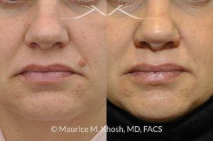 Photo of a patient before and after a procedure. Mole removal from the left upper lip - before and after results.